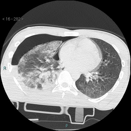 Blunt chest trauma (Swiss cheese sign) (Radiopaedia 38519-40618 Axial lung window 45).jpg
