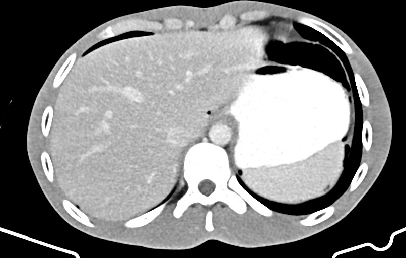 Blunt injury to the small bowel (Radiopaedia 74953-85987 A 12).jpg