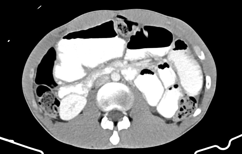 Blunt injury to the small bowel (Radiopaedia 74953-85987 A 73).jpg