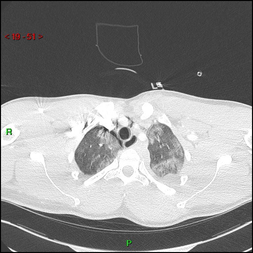 Blunt thoracic trauma (Radiopaedia 73454-84221 Axial lung window 18).jpg