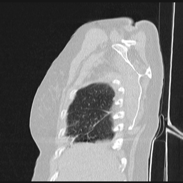 Boerhaave syndrome (Radiopaedia 45644-49799 Sagittal lung window 8).jpg