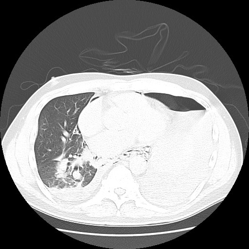 Boerhaave syndrome (Radiopaedia 59796-67310 Axial lung window 39).jpg