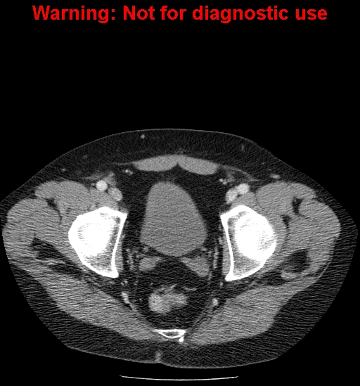 File:Bosniak renal cyst - type IV (Radiopaedia 23402-23466 D 74).jpg