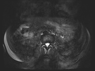 Bouveret syndrome (Radiopaedia 61017-68856 Axial MRCP 50).jpg