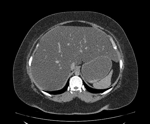 Bowel and splenic infarcts in acute lymphocytic leukemia (Radiopaedia 61055-68913 A 35).jpg