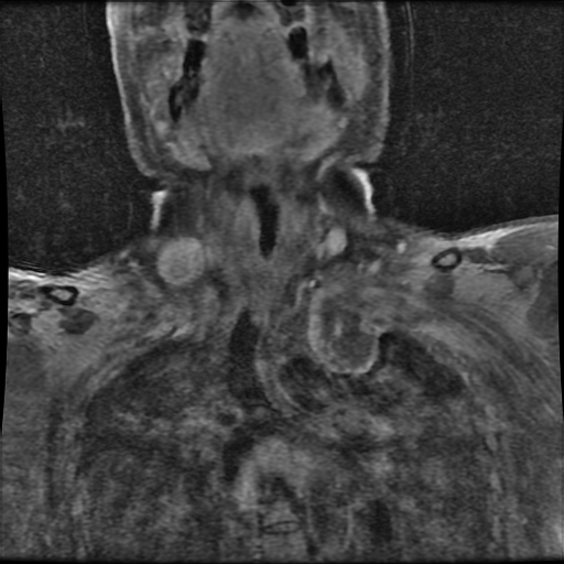 File:Brachial plexus neurofibroma (Radiopaedia 28030-28291 H 4).png