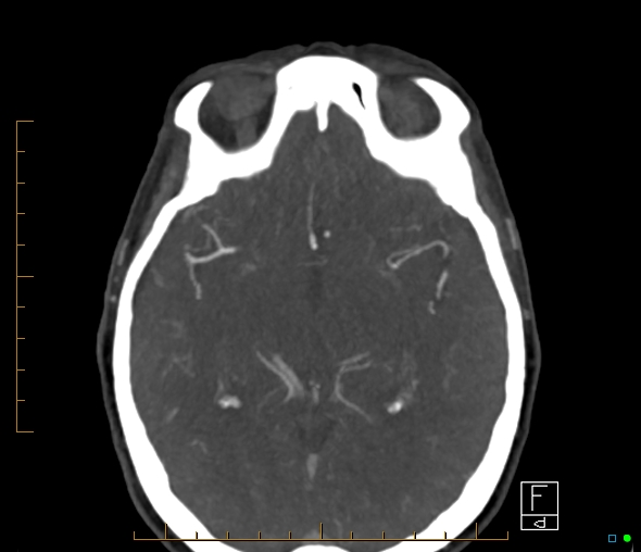 Brachiocephalic trunk stenosis (Radiopaedia 87242-103519 A 38).jpg
