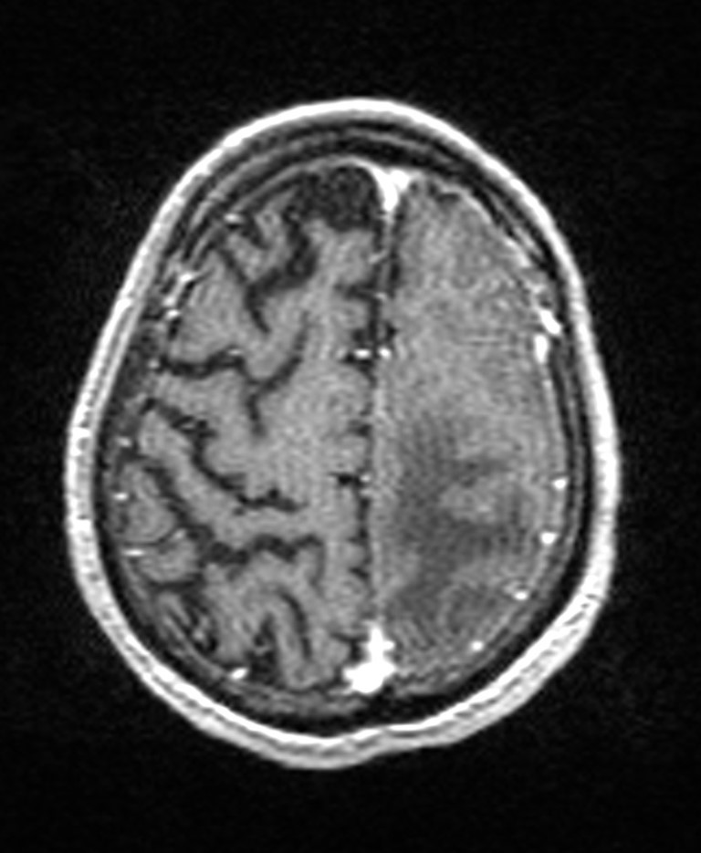 Brain abscess with dual rim sign (Radiopaedia 87566-103938 Axial T1 C+ 131).jpg