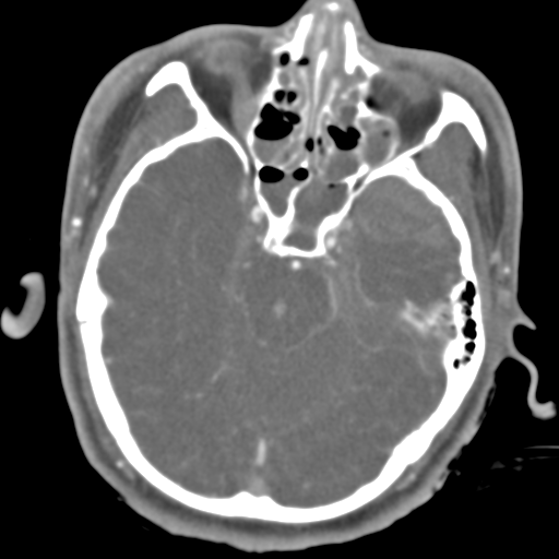 Brain contusions, internal carotid artery dissection and base of skull fracture (Radiopaedia 34089-35339 D 37).png