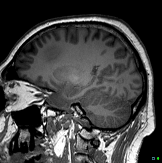 Brain death on MRI and CT angiography (Radiopaedia 42560-45689 Sagittal T1 2).jpg