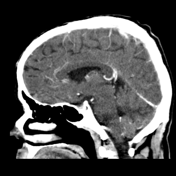Brain metastases from lung cancer (Radiopaedia 24480-24781 C+ delayed 28).jpg