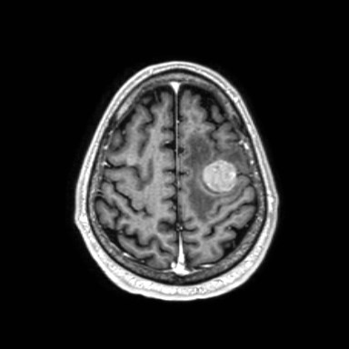 File:Brain metastases from lung cancer (Radiopaedia 83839-99028 Axial T1 C+ 55).jpg