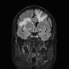 Brain metastases from lung cancer (Radiopaedia 83839-99028 Coronal FLAIR 33).jpg