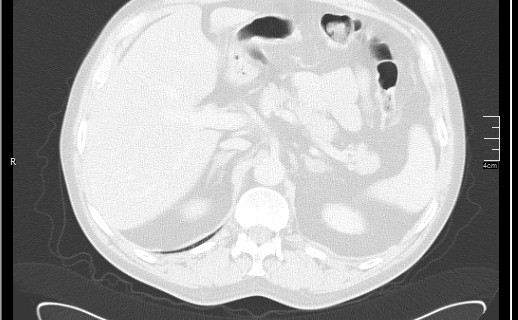 Brain metastases from squamocellular lung cancer (Radiopaedia 56515-63219 Axial lung window 64).jpg