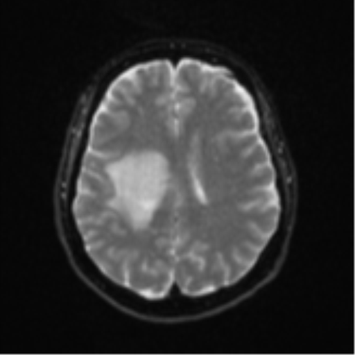 Brain metastasis (sarcoma) (Radiopaedia 47576-52209 Axial DWI 17).png