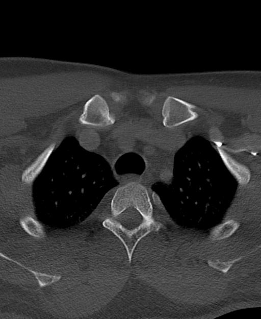 Branchial cleft cyst (Radiopaedia 31167-31875 Axial bone window 75).jpg