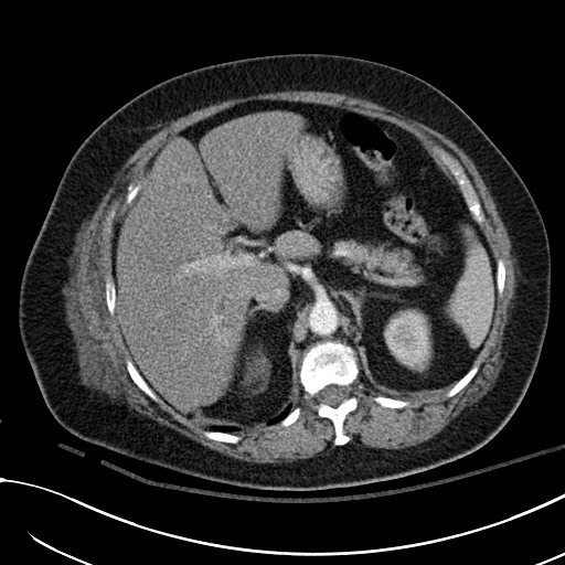 File:Breast carcinoma with pathological hip fracture (Radiopaedia 60314-67974 A 52).jpg
