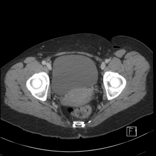File:Breast metastases from renal cell cancer (Radiopaedia 79220-92225 C 109).jpg