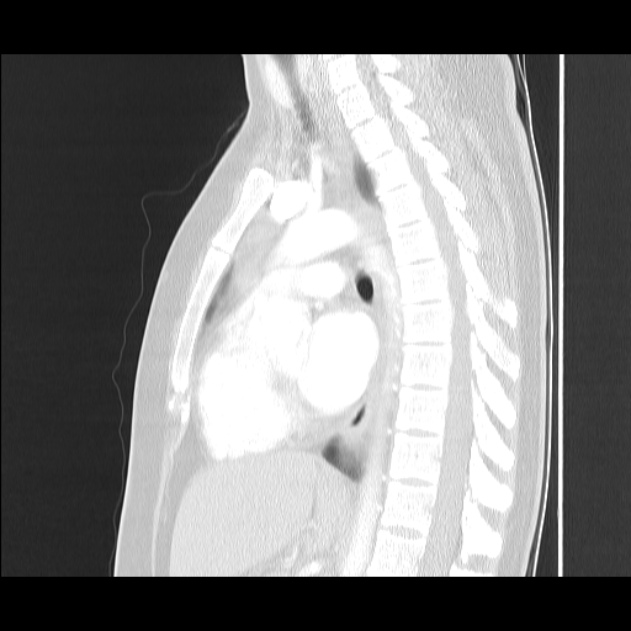 Bronchial atresia (Radiopaedia 22965-22992 Sagittal lung window 27).jpg