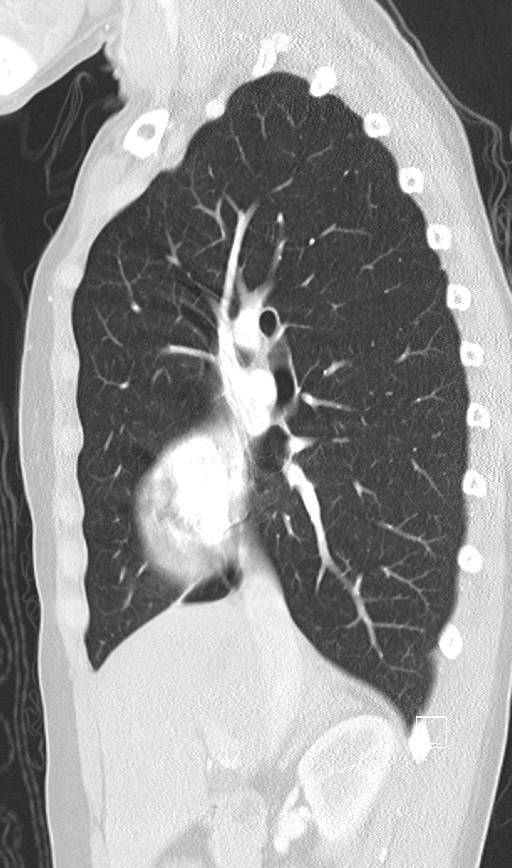Bronchial atresia (Radiopaedia 73677-84470 Sagittal lung window 21).jpg