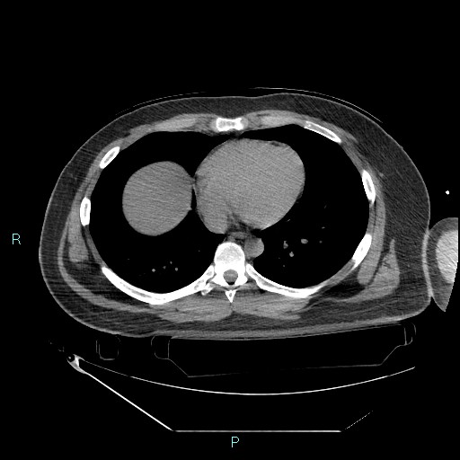 Bronchial carcinoid tumor (Radiopaedia 78272-90870 Axial non-contrast 70).jpg