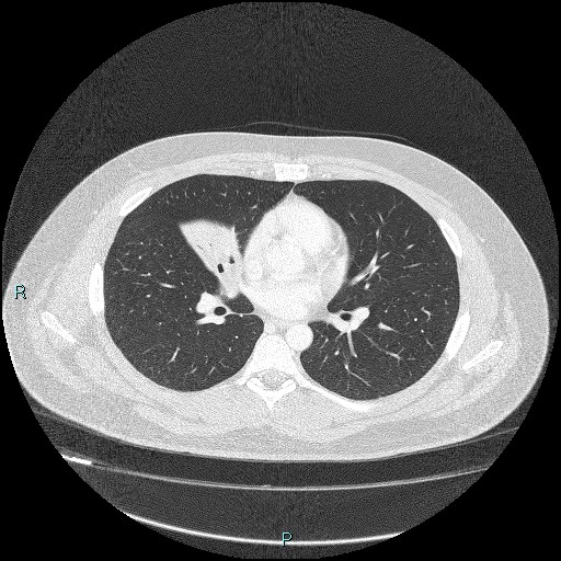 Bronchial carcinoid tumor (Radiopaedia 78272-90875 Axial lung window 26).jpg