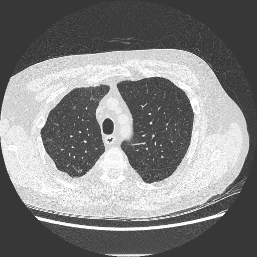 File:Bronchial stenosis - lung transplant (Radiopaedia 73133-83848 B 9).jpg
