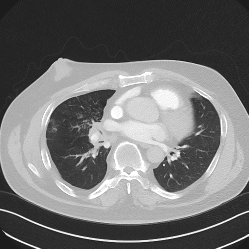 File:Bronchiectasis (Radiopaedia 39385-41666 Axial lung window 36).png