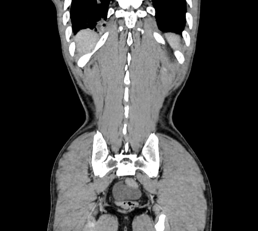 Bronchiectasis in Crohn disease (Radiopaedia 60311-67977 C 77).jpg