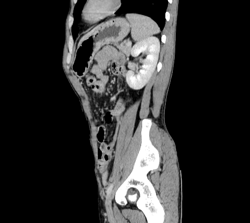 Bronchiectasis in Crohn disease (Radiopaedia 60311-67977 D 85).jpg