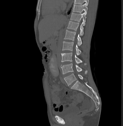 Bronchiectasis in Crohn disease (Radiopaedia 60311-67977 Sagittal bone window 115).jpg