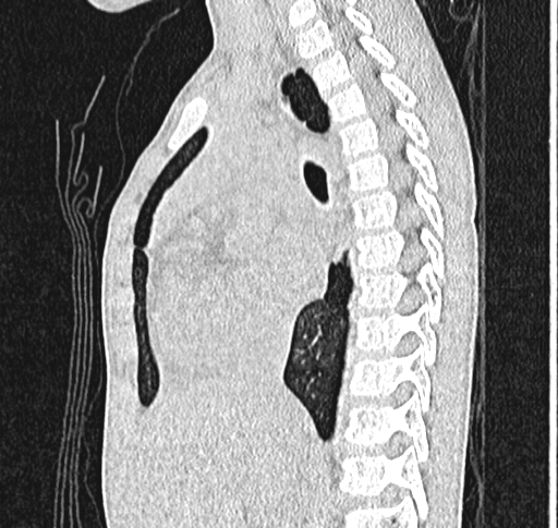 Bronchiolitis obliterans (Radiopaedia 71538-81897 Sagittal lung window 30).jpg