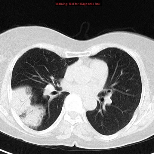 File:Bronchoalveolar carcinoma (BAC) (Radiopaedia 13436-13392 Axial lung window 27).jpg