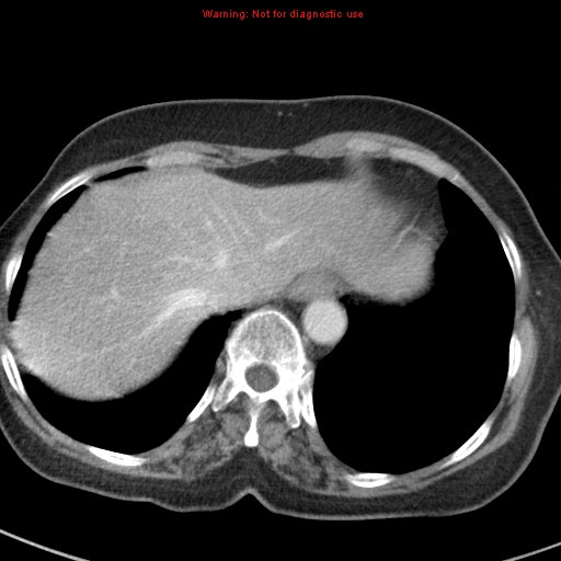 File:Bronchoalveolar carcinoma (BAC) (Radiopaedia 13436-13392 B 45).jpg