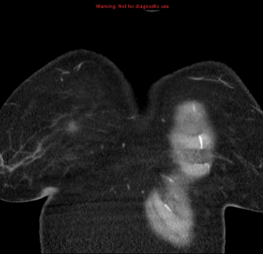 Bronchoalveolar carcinoma (BAC) (Radiopaedia 13436-13392 E 3).jpg