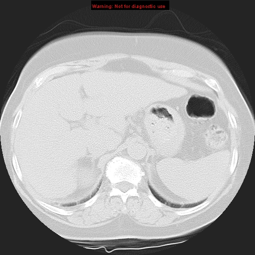 File:Bronchoalveolar carcinoma (Radiopaedia 13224-13233 Axial lung window 47).jpg