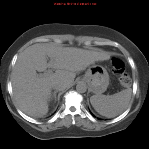 Bronchoalveolar carcinoma (Radiopaedia 13224-13233 Axial non-contrast 41).jpg