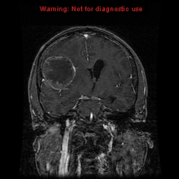 File:Bronchogenic carcinoma brain metastasis (Radiopaedia 9286-9969 Coronal T1 18).jpg