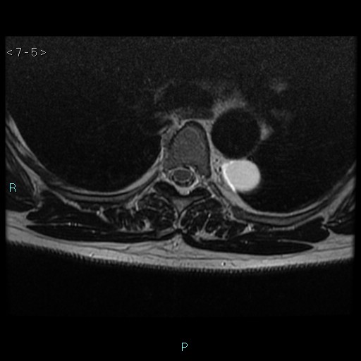 File:Bronchogenic cyst - posterior mediastinal (Radiopaedia 43885-47365 Axial T2 5).jpg