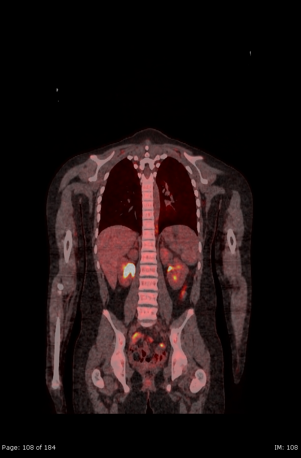 Brown fat uptake (FDG PET-CT) (Radiopaedia 77392-89513 Fused coronal 66).jpg