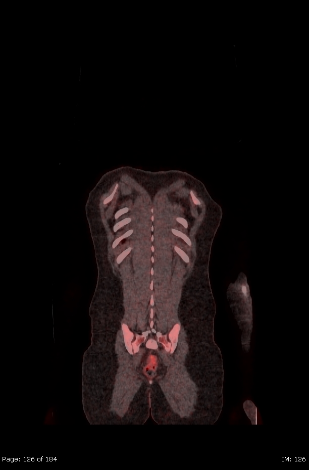 Brown fat uptake (FDG PET-CT) (Radiopaedia 77392-89513 Fused coronal 84).jpg