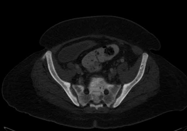 Brown tumors compressing the spinal cord (Radiopaedia 68442-77988 G 99).jpg