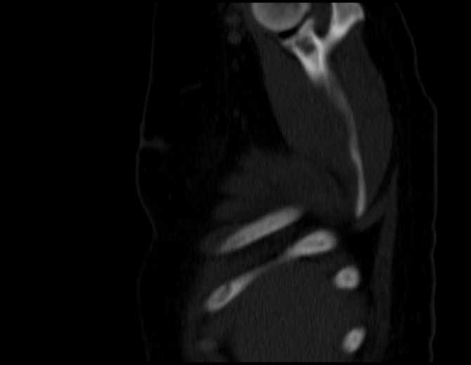 Brown tumors compressing the spinal cord (Radiopaedia 68442-77988 Sagittal bone window 7).jpg