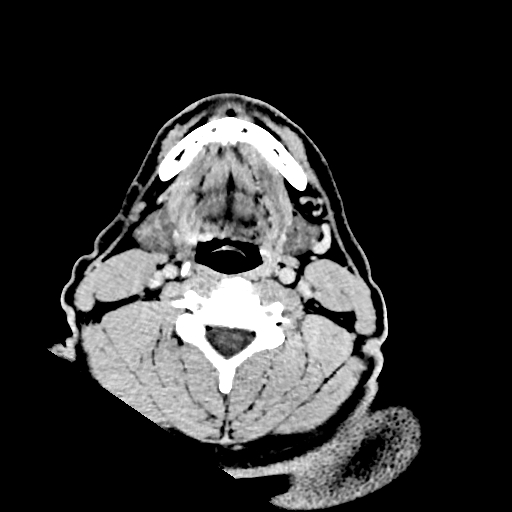 Buccal fat pad arteriovenous malformation (Radiopaedia 70936-81142 Axial non-contrast 1).jpg