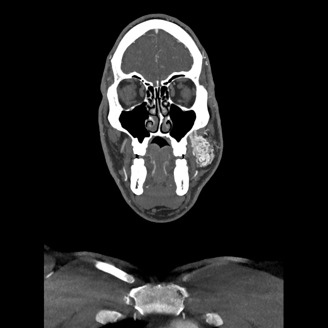 Buccal fat pad arteriovenous malformation (Radiopaedia 70936-81144 B 12).jpg