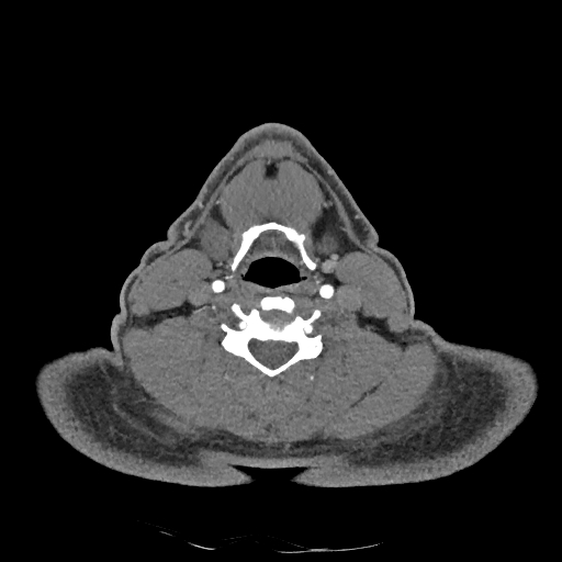 Buccal fat pad arteriovenous malformation (Radiopaedia 70936-81144 D 125).jpg
