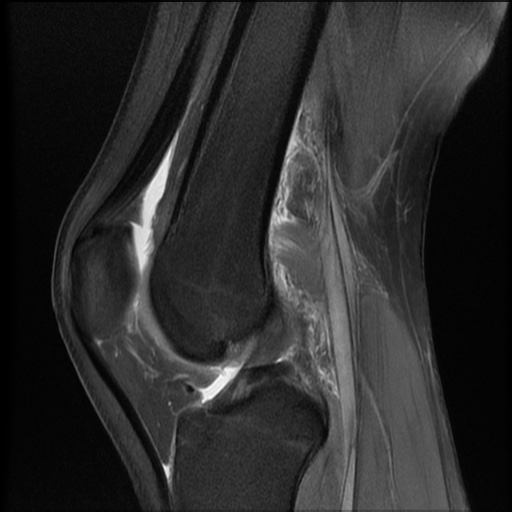 File:Bucket-handle meniscus tear (Radiopaedia 65700-74809 Sagittal PD fat sat 13).jpg