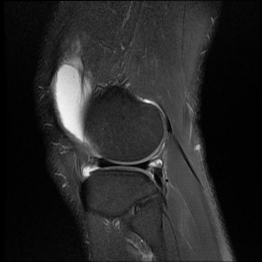 File:Bucket handle tear - medial meniscus (Radiopaedia 69245-79026 Sagittal PD fat sat 3).jpg