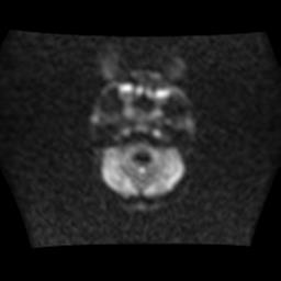 File:Burkitt lymphoma of the orbit- pre and post chemotherapy (Radiopaedia 31214-31930 Axial DWI 4).jpg