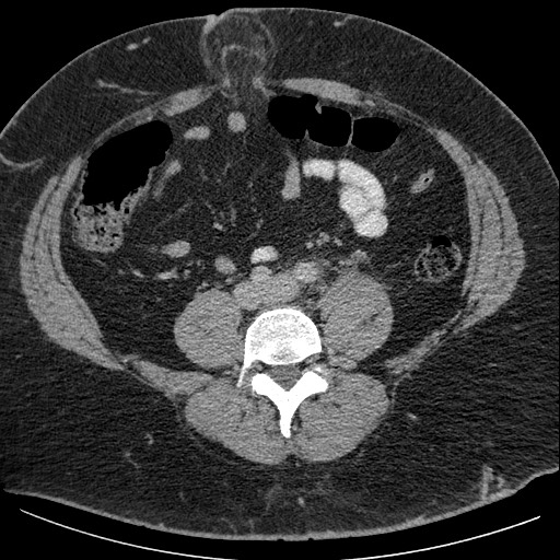 Burned-out testicular seminoma - retroperitoneal nodal metastases (Radiopaedia 62872-71245 A 47).jpg